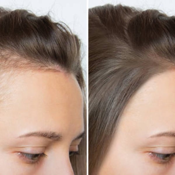 Cropped before and after head shot of a young woman with bald patches on her forehead and temples. Baldness. Close-up, side view. Hair care and treatment concept. Hair loss, hair extensions, alopecia.