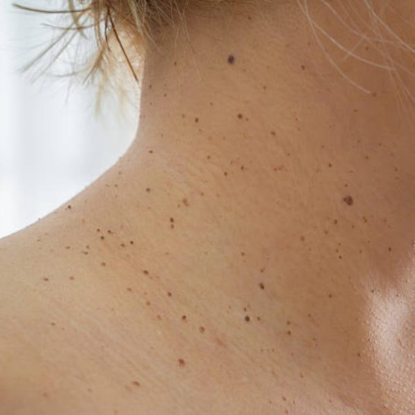 Close-up of an Asian woman's neck, with sun-affected skin showing moles and freckles—highlighting pigmentation and skin health issues.