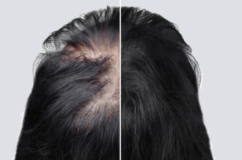 Women baldness alopecia. Hair after using cosmetic powder to thicken hair. Before and after.