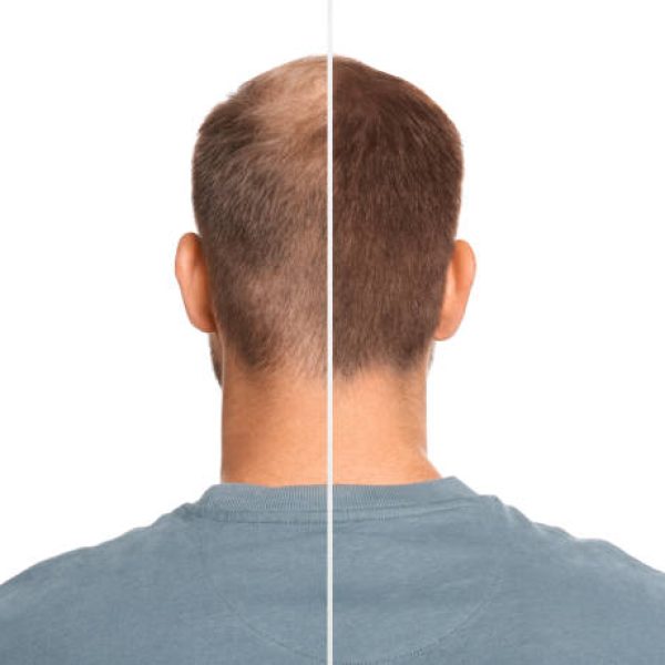 Man with hair loss problem before and after treatment on white background, collage. Visiting trichologist